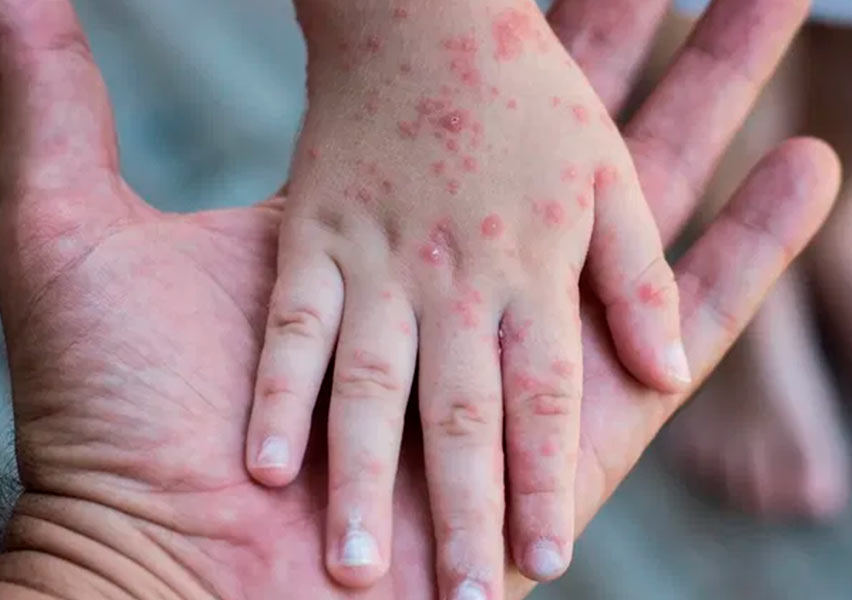 Rubella virus