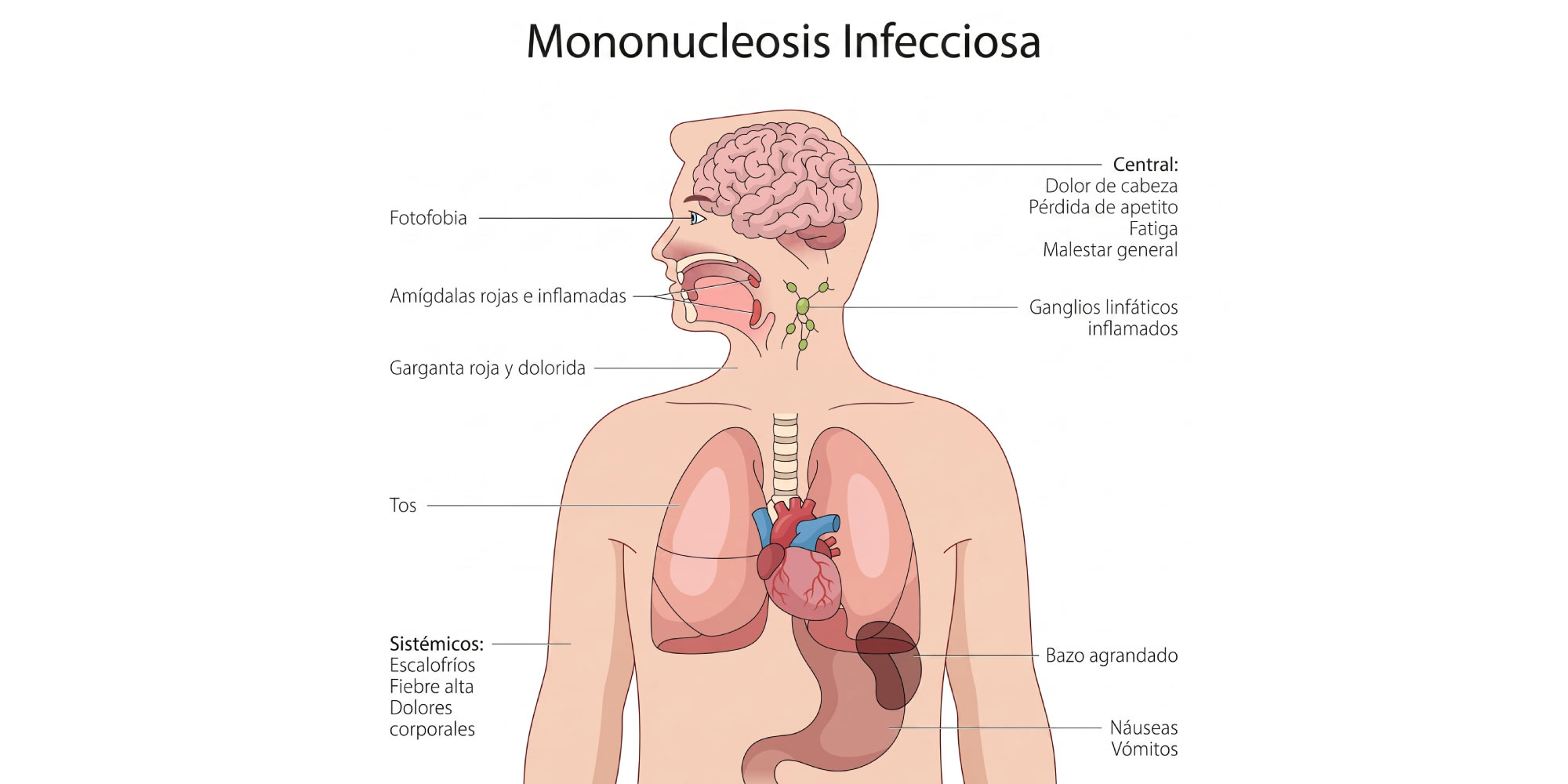 sintomas de la mononucleosis infecciosa