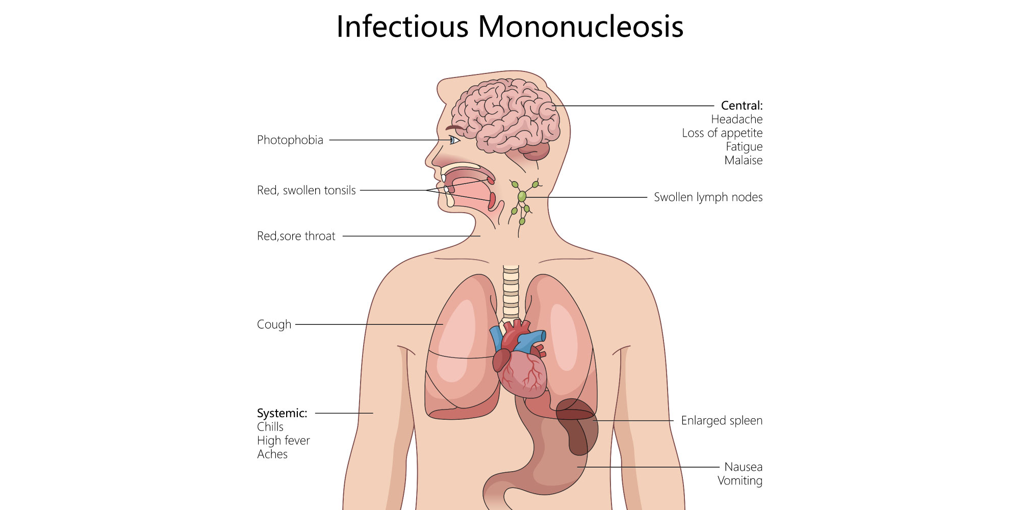 infectious mononucleosis symptoms
