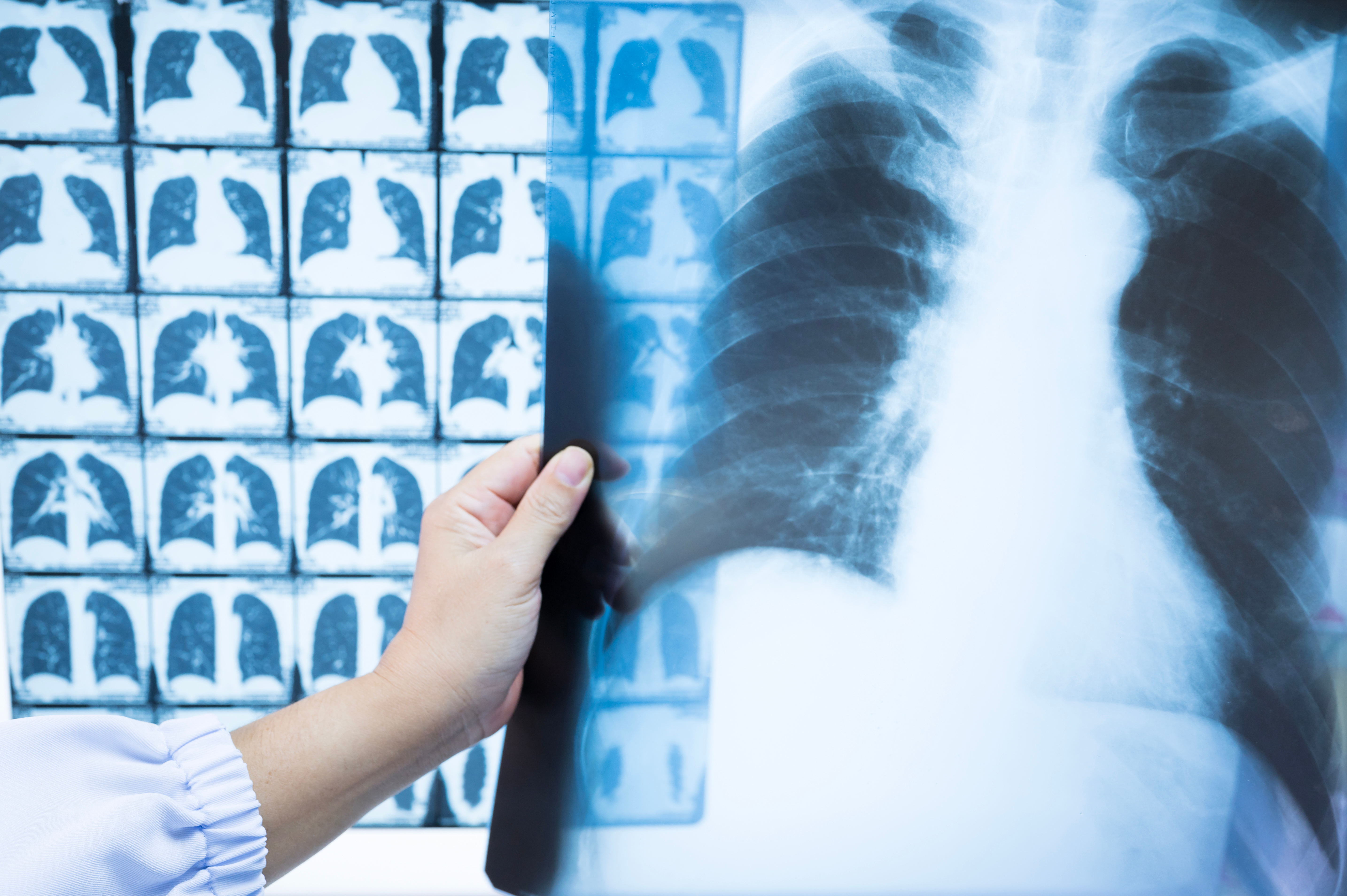 radriografia de pulmones