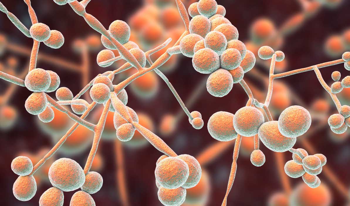 Candidiasis