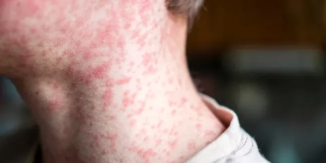 pcr measles