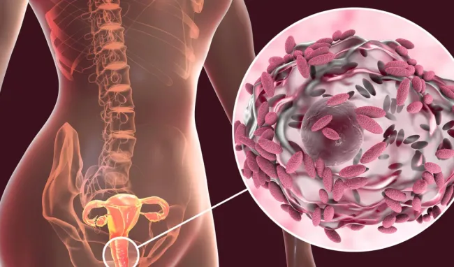 VAGINOSIS INFECTION