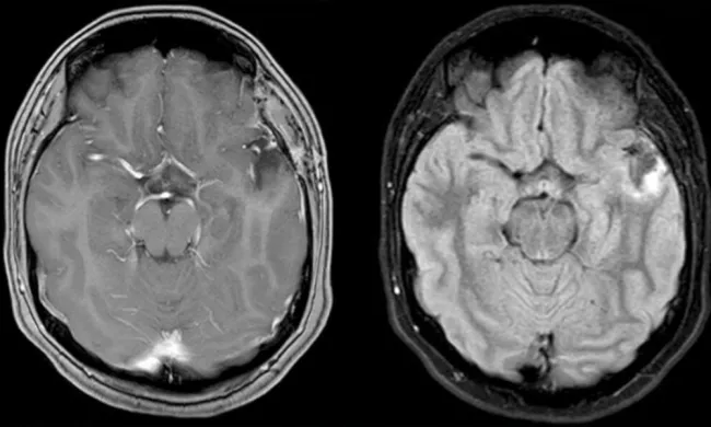 neurobrucellosis diagnosis