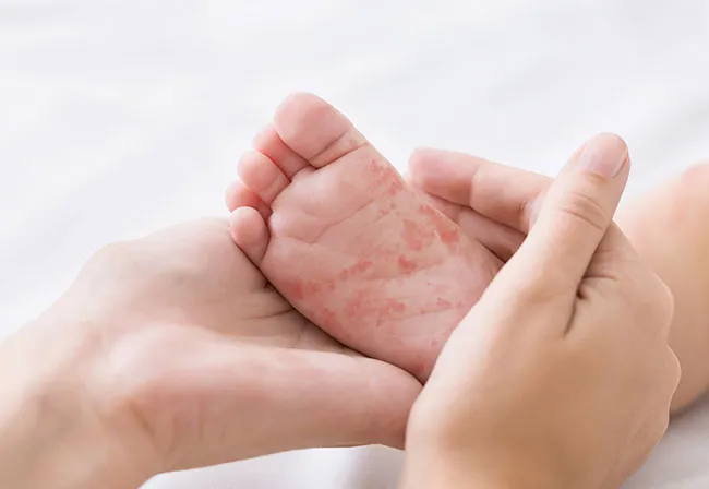 measles solutions